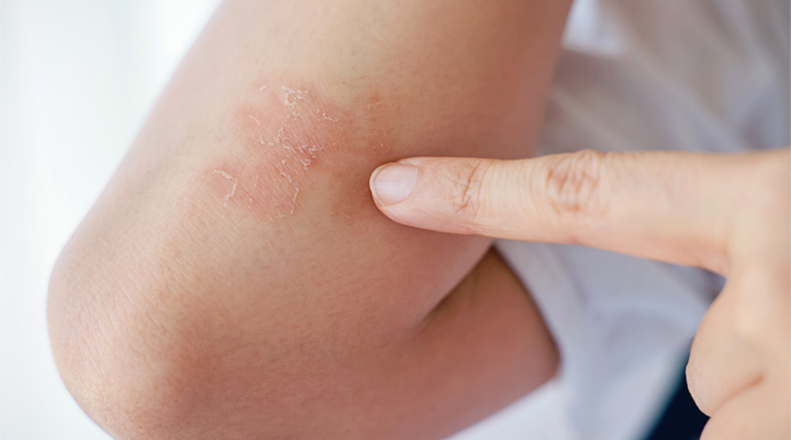 Cambiamenti climatici e aumento della dermatite: come intervenire in modo efficace