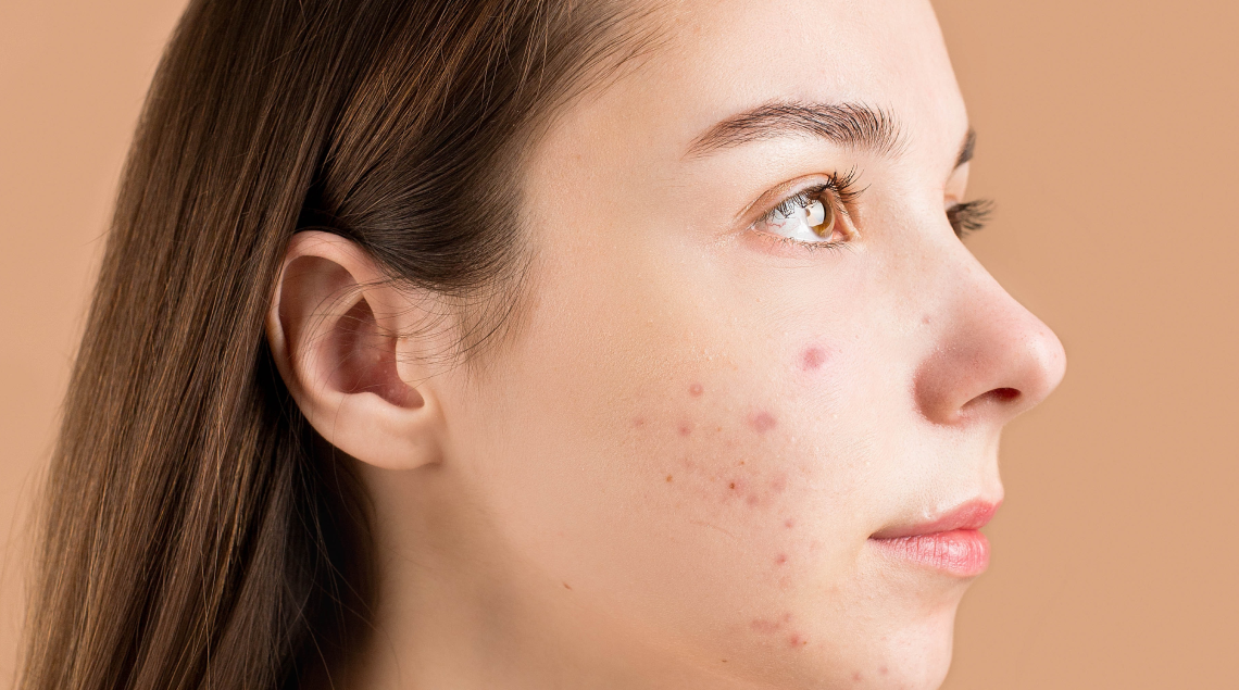 Macchie solari: cause, prevenzione e trattamenti efficaci