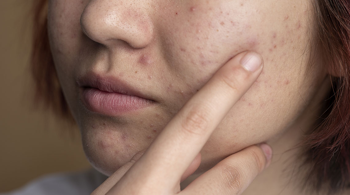 Macchie Rosse sulla Pelle: Cosa Sono, Cause e Rimedi